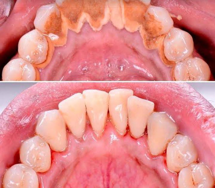 LIMPIEZA DENTAL PROFUNDA